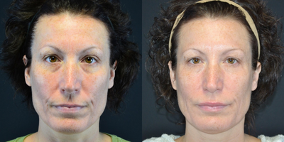 45-54 year old woman treated with Restylane - 46 year old female who received Restylane to the upper lip and Bellafill to nasolabial folds and marionette lines ; 2 weeks post-procedure.