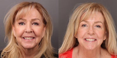 65-74 year old woman treated with Sylfirm X, Laser Resurfacing - 2 Sylfirm X Laser Treatments with Sarah Olsen. No filler or botox. 6 months post-treatment, age 65 years.