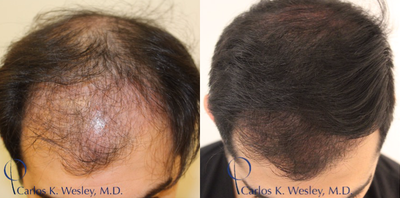 25-34 year old man treated with PRP Injections - Patient treated with PRP for Hair loss