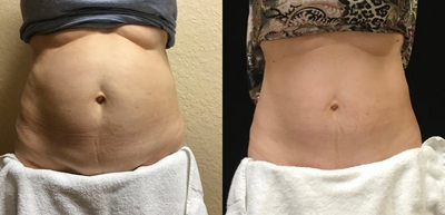 55-64 year old woman treated with truSculpt iD - 55-64 year old woman treated with truSculpt iD to sculpt her abdomen. TruSculpt Flex was also used to tone the area and strengthen the muscles.