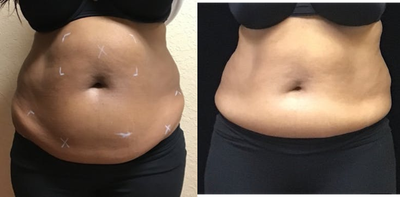 35-44 year old woman treated with truSculpt iD - 35-44 year old woman treated with truSculpt iD to lower abdomen and flanks. Patient had trouble shrinking her bodydue to hormones and diet.