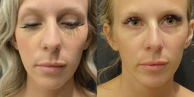 Woman treated with Rhinoplasty - Woman treated with Rhinoplasty