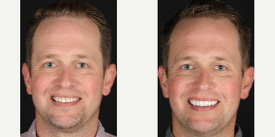 Man treated with Gum Lift - Treatment: gum lift & 10 porcelain veneers
