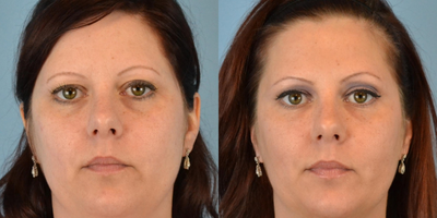 35-44 year old woman treated with ArteFill - 38 year old female received Artefill to tear troughs