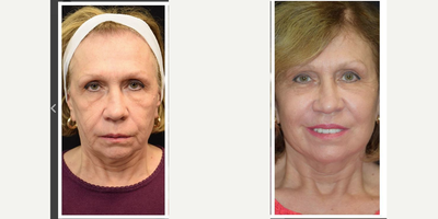 55-64 year old woman treated with Thread Lift - Combination therapy to address aging concerns.Fillers for volume loss and Eurothreads for tightening and lifting.