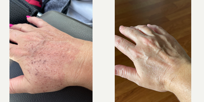 41 year old woman treated with Lumecca - After only 1 Lumecca treatment, this patient's aging hands transformed into completely new youthful hands!