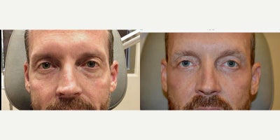 35-44 year old man treated with Fractional Laser - Under-eye bags and hollow cheeks are corrected by scarless lower eyelid surgery, fat transfer to the lower eyelids/cheek, and CO2 laser skin resurfacing.