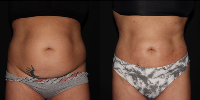 45-54 year old woman treated with Renuvion - Liposuction and Renuvion to abdomen and flanks