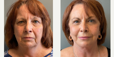 65-74 year old woman treated with Deep Plane Facelift, Neck Lift, Renuvion - Patient wanted to reduce signs of aging and fix skin laxity. Patient received face and neck lift with renuvion.