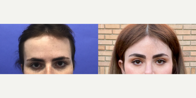 Patient treated with Forehead Reduction, Brow Lift - Forehead Lift, Hairline Lowering, Orbital Bony Contouring - 25 to 34 year-old female patient is 1 year post-op from Facial Feminization surgery. Her procedures included: Forehead Lift, Hairline Lowering, Orbital Bony Contouring, Septorhinoplasty (open) with Cartilage Grafts and Weirs, Cheek Implants (small combined), 2 cc Voluma to Medial Cheeks, Chin Reduction and Contour, Thyroid Cartilage Shave, Intranasal Lip Lift with Fat Augmentation, Soft Tissue to Nasolabial Folds, and 300 Micrografts to the Fronto Temporal Recessions.