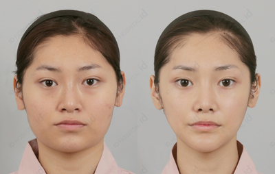 18-24 year old woman treated with V Line Surgery - Square Jaw Surgery in ID hospital