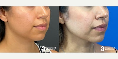 35-44 year old woman treated with AccuTite - The patient is a 38-year-old female who had concerns with the appearance of her lower face and neck. Dr. Cho performed accutite to the lower face and neck. After photos are 1 year post procedure.