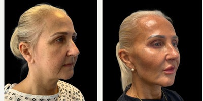 55-64 year old woman treated with Deep Plane Facelift, Facelift, Facial Fat Transfer, Eyelid Surgery, Lip Lift, Chin Implant - procedures:An extended deep plane faceliftDeep neckliftFat transfer to cheekschin implantLip liftBuccal fat removalLower blepharoplasty using transconjunctival fat repositioning