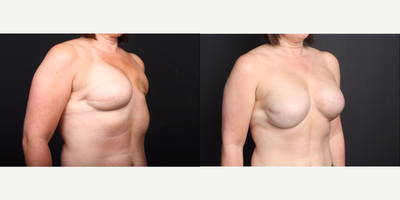 45-54 year old woman treated with AlloDerm - Reconstruction and revision with 
1. Left Latissimus Dorsi Flap
2. AlloDerm
3. Natrelle 410 MX 620cc implants 
4. Fat injection