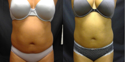 35-44 year old woman treated with BodyFX - Patient after 1 treatment.