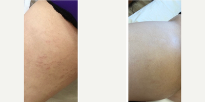 25-34 year old woman treated with Dermapen - Patient had 3 Dermapen sessions for stretch marks