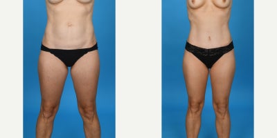 35-44 year old woman treated with Abdominal Etching, Diastasis Recti Repair, Drainless Tummy Tuck, Liposculpture, Liposuction, M - Standard tummy tuck with VASER ultrasound liposuction 360 and corset muscle plication.