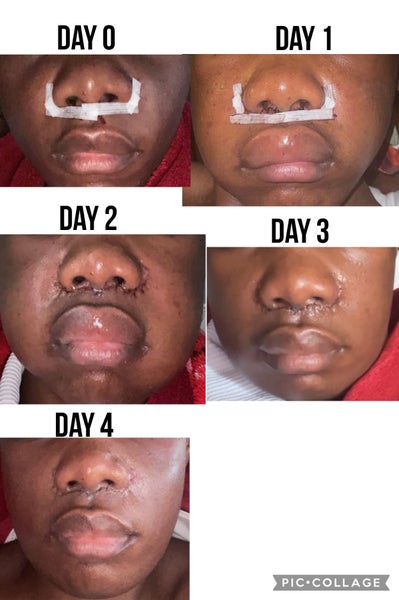 therapeutic goods administration melanotan ii warning Abnormal moles seen developing in patients chasing perfect suntan by using  peptide melanotan-II