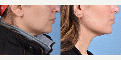Woman treated with Thermage - This patient had Full Face and Neck Thermage FLX Treatment. The after images are shown at 1 month post treatment.