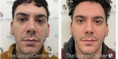 25-34 year old man treated with Earfold - 25-34 year old man treated with Earfold