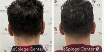 25-34 year old man treated with Earfold - 25-34 year old man treated with Earfold