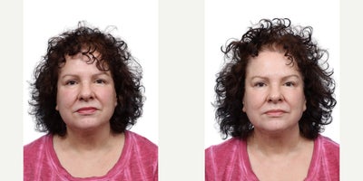 Woman treated with Skin Tightening with XERF - Woman treated with Skin Tightening with XERF