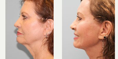 Woman in her late 60s treated with Facial Fat Transfer - Woman in her late 60s treated withFacial Fat Transfer as well asFaceliftand TFXLaser Resurfacing, shown 3 months post op. Pre-op, patient was concerned about the excess skin around her jowls and neck.