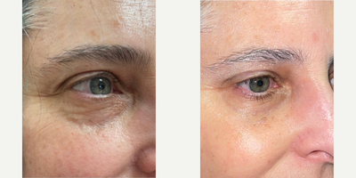 Woman treated with Skin Rejuvenation - Non-surgical eye rejuvenation