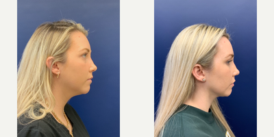 25-34 year old woman treated with Liposuction - 6 months post-liposuction of the neck