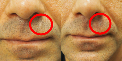 35-44 year old man treated with Scalp Micropigmentation to Scar on the Beard/ Mustache - A small SMP procedure for beard hair scar.