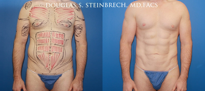 Man treated with Tricep Implants - Man treated with Tricep Implants