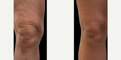 55-64 year old woman treated with Vivace - VIVACE RF (3 Sessions) Taken 4 weeks after final session