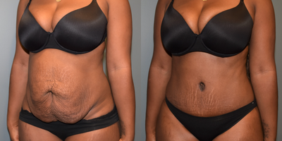 25-34 year old woman treated with Tummy Tuck - This 32 year old mother of two has been pregnant five times. She had a very wide separation of her abdominal muscles, (rectus diastasis). She weighs 156 pounds and is 53 tall. She had a tummy tuck with liposuction to the flank area which removed 2 pounds and 300 cc respectively. Her results are shown early at just 2 months; already the scar looks great.