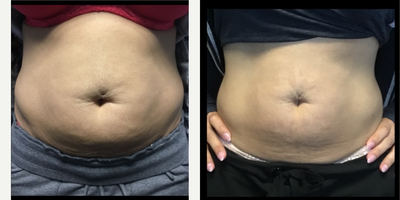35-44 year old woman treated with Morpheus8 on Abdomen - The patient received one Morpheus8 treatment to the abdomen area. After photo was taken 12 weeks post-treatment. Note: The patient did also lose 4 lbs from diet and exercise.