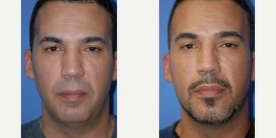 Man treated with Chin Implant - Man treated with Chin Implant