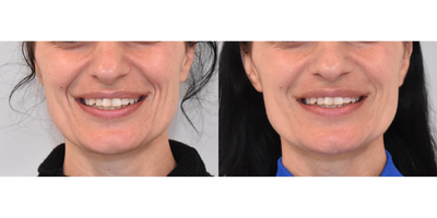 Dynamic Smile Lines Treated with Filler - This patient had lower facial dynamic lines that were more noticeable when smiling. Restylane Refyne was injected to soften creases around the mouth. After photos were taken two weeks post treatment.
