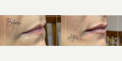 Woman treated with Lip Fillers - Woman treated with Lip Fillers.