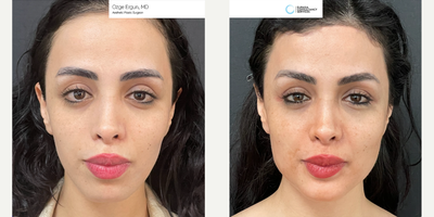 25-34 year old woman treated with Chin Implant, Brow Lift - Chin&Jaw Implant, Brow Lift