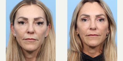 45-54 year old woman treated with Eyelid Surgery - This 50-year-old patient was concerned the appearance of her heavy upper eyelids and did not like how aged and tired they made her look. Dr. Wise performed an upper blepharoplasty , resulting in her eyes looking brighter with a more refreshed look.