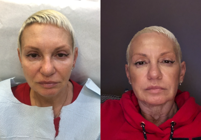 55-64 year old woman treated with Silhouette InstaLift - Silhouette instaLift is unique minimally invasive treatment that immediately redefines mid-face contours for a natural, younger look