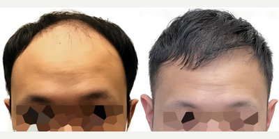 29 year old man treated with FUE Hair Transplant, Minoxidil and Finasteride - This is a gentleman who came to us at only age 29 for a hair transplant. His hair loss began in his early 20s and in only a few short years progressed to at least a Norwood Stage 5, or maybe beyond. He had never tried any evidence-based treatments to slow or reverse his hair loss. Despite his young age, he had complete obliteration of his hairline and front scalp, with near complete loss in the midscalp through to the crown. The result was disproportionate features, the loss of the frame to his face, and the appearance of being much older than his 29 years. Fortunately, he had an excellent donor area. Prior to surgery, we discussed the importance of supplementary non-surgical therapies like finasteride and minoxidil to help him preserve the hair he still had. In this way, we could use a hair transplant to replace what hes lost, knowing that hed be highly unlikely to lose additional hair in other areas. As a result of his large and dense donor area, we were able to perform a 3146 graft FUE surgery. This is one of the largest single session FUE surgeries ever performed at Toronto Hair Transplant Centre and is a larger graft amount for this type of surgery than average. You can see from our surgical drawings that his goal was not to achieve an overly aggressive hairline, but rather to have a natural hairline that preserved enough donor grafts to add some density in the midscalp and crown, while still giving him a frame to his face and good coverage upfront. He wanted the kind of hairline that would continue to look natural into his 30s, 40s, 50s and beyond. The majority of the grafts were distributed to the frontal scalp to rebuild the density there, while a few were added to the midscalp and crown. We knew this would not add overly thick density to those areas, but it would still make a significant difference. This patient returned to see us 13 months after his surgery. His results are absolutely amazing! He looks like, well, just a guy with hair! His forehead is much less prominent and he looks much more youthful and in line with his age. You can see in the detailed photo of his hairline that it looks completely natural and no one could ever tell hes had a hair transplant. His donor area continues to look dense without any noticeable evidence of even a large FUE harvest. He continues to use finasteride and minoxidil regularly, without any problems, and hasnt lost any additional hair. He looks great!