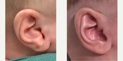 Person treated with Ear Surgery - Person treated with Ear Surgery