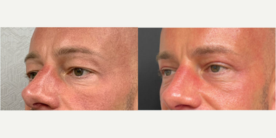 Man treated with Eyelid Surgery - Man treated with Eyelid Surgery