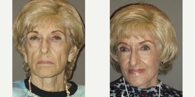 75 and up year old woman treated with Laser Resurfacing - 84 yr oldjplasma patient