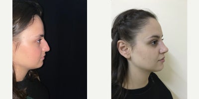 25-34 year old woman treated with Rhinoplasty - Natural, slightly curvy female nose that perfectly fits the patients facial features and creates a harmonious appearance from every angle.