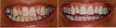 Clear Braces combined with Composite Bonding - Tooth straightening with clear brackets and tooth-coloured wires completed in under 4 months. Tooth whitening to brighten, followed by Composite Bonding and Contouring to perfect the result in time for an awesome client's wedding day.