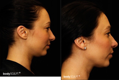 25-34 year old woman treated with Kybella - Here are the before and after images of a patient, who has benefited from Kybella treatment at our practice.