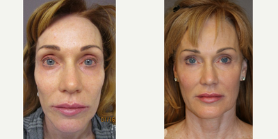 Sculptra and Botox, fixing prior placement of Vouma from outside - Came in to me overprojected to the front from Voluma done elsewhere. Utilized the volume to blend with the remainder of the lower eyelids, cheeks, and around the mouth.
