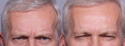 Botox - This patient came in to address aging at the forehead. After visiting with Dr. Ho, the patient received a botox treatment.