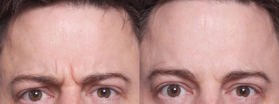 Botox - This patient came concerned about the appearance of his forehead area. After consulting with Dr. Ho, the patient elected to receive a botox treatment to smooth and soften the area.